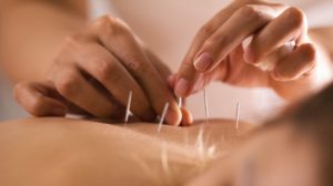 Things You Might Feel After Getting Acupuncture